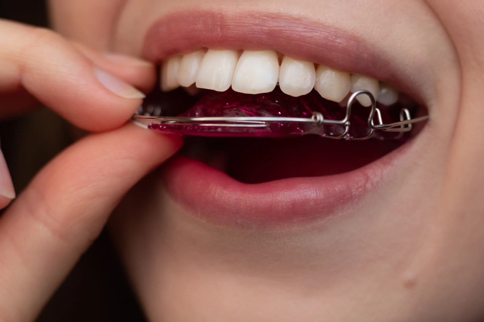 A removable retainer being seated over the upper teeth, wire clasps visible