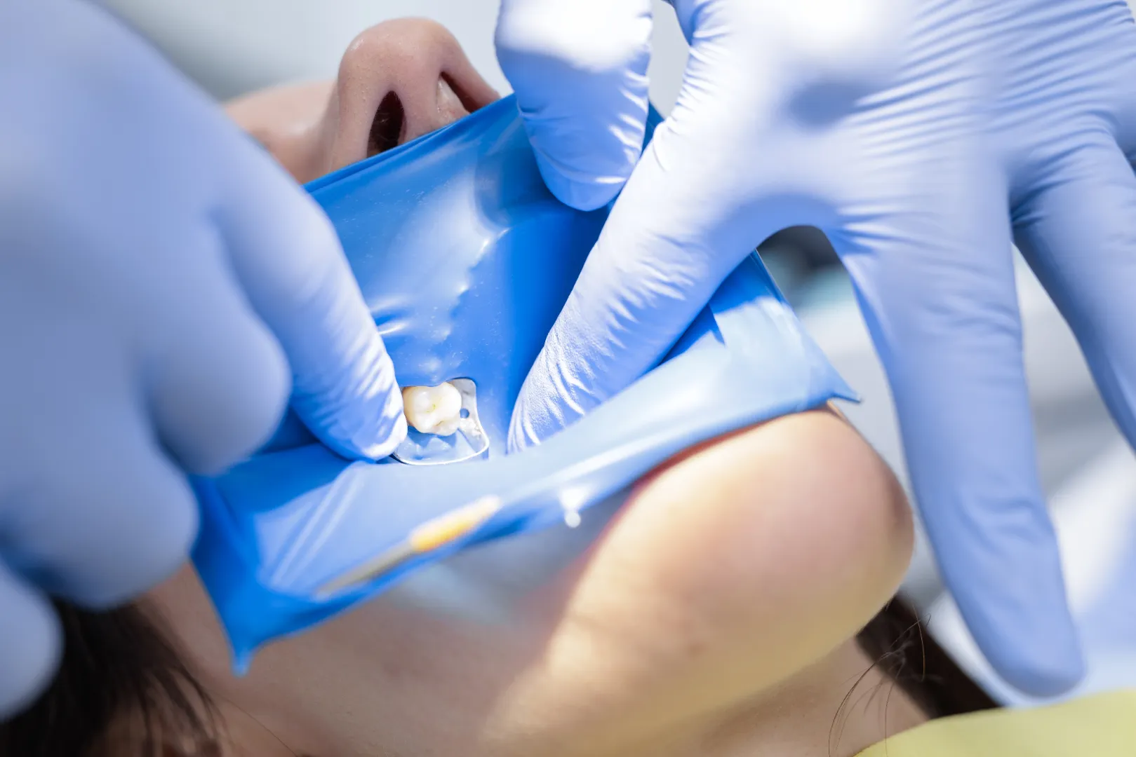 Root canal therapy