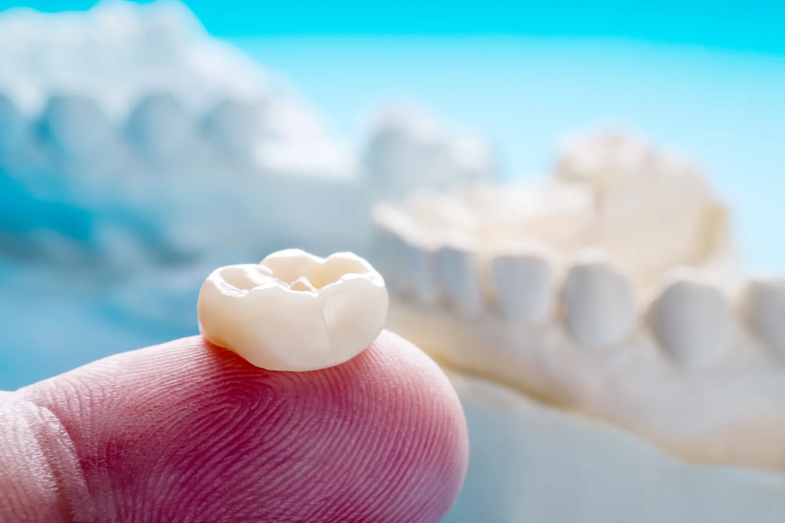 Same-day dental crown guide